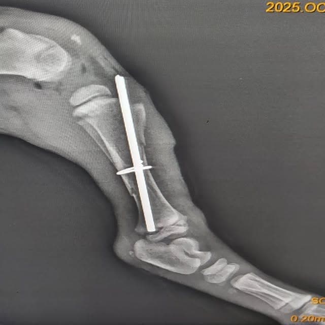 Femur kırığı intramedüler pin uygulaması röntgen