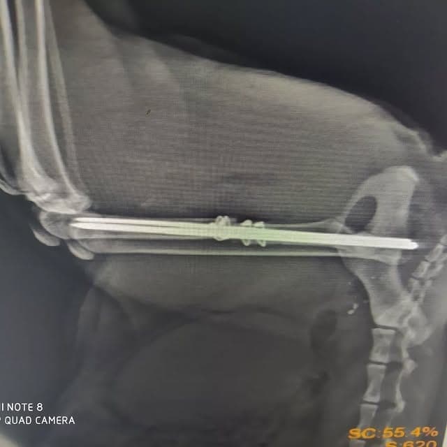 Femur kırığı serklaj teli ile onarım röntgen görüntüsü